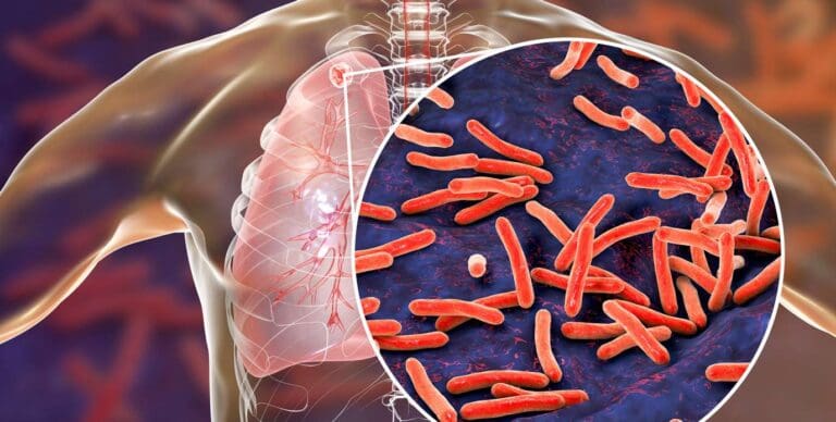 Africa records further decline in TB deaths, cases